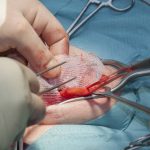 Hernia Surgery in Hyderabad | Best Hernia Specialist in Hyderabad:Dr. N. S. Babu