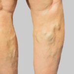 Varicose Veins Treatment in Bangalore