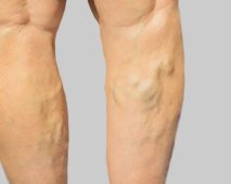 Varicose veins treatment